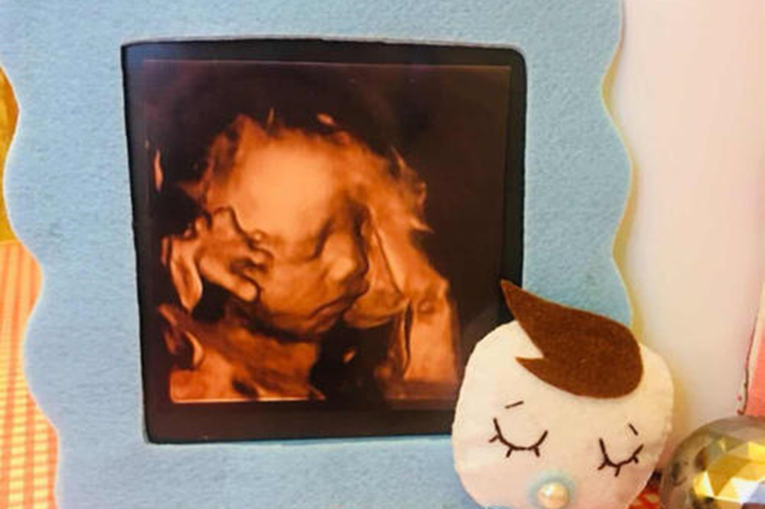 孕期看宝宝照片管用吗,孕期四维彩超看五官