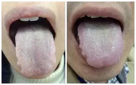 舌头辨体质,看舌头能看出几种体质