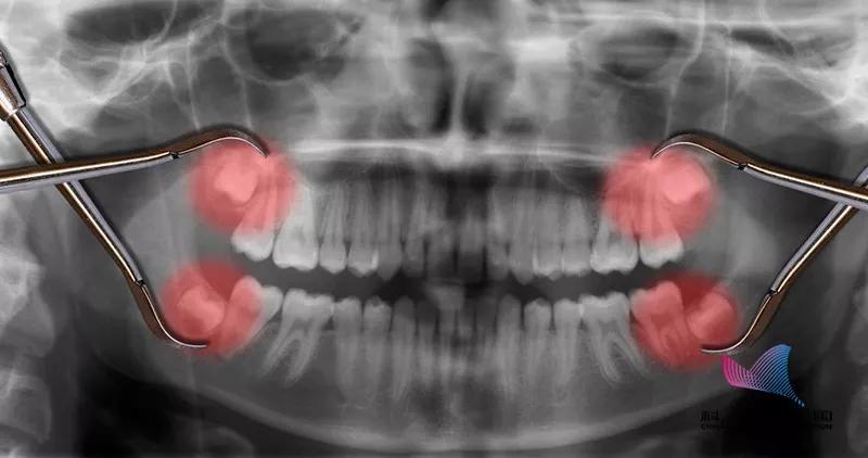 明星拔了智齿有垮脸的吗,明星拔完智齿