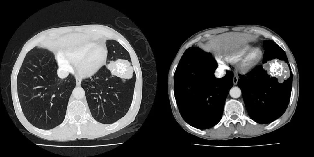 肺内见多发小囊状无纹理透光影,肺内肿块并厚壁空洞