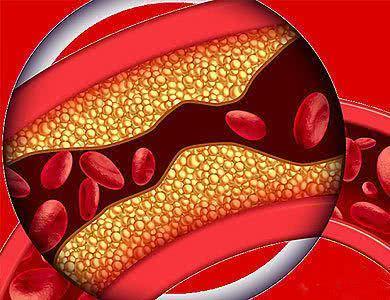 颈动脉有斑块可以吃降血脂中成药,有颈动脉斑块的适合吃什么降压药