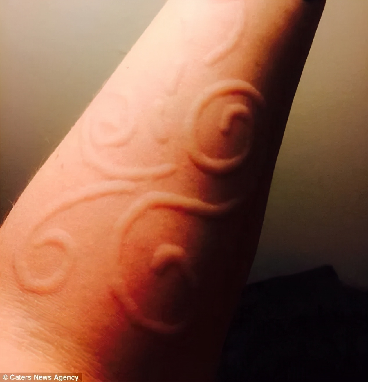 得了麻疹自己会好吗,得了荨麻疹会变成敏感肌吗