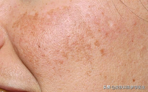 30岁面部斑点越来越多的原因,脸部色斑不及时治疗的图片