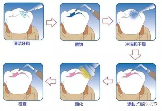 孩子换牙时需要注意些什么,小孩换牙期的注意事项