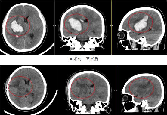 35岁高血压突然脑出血,32岁小伙高血压突发脑出血