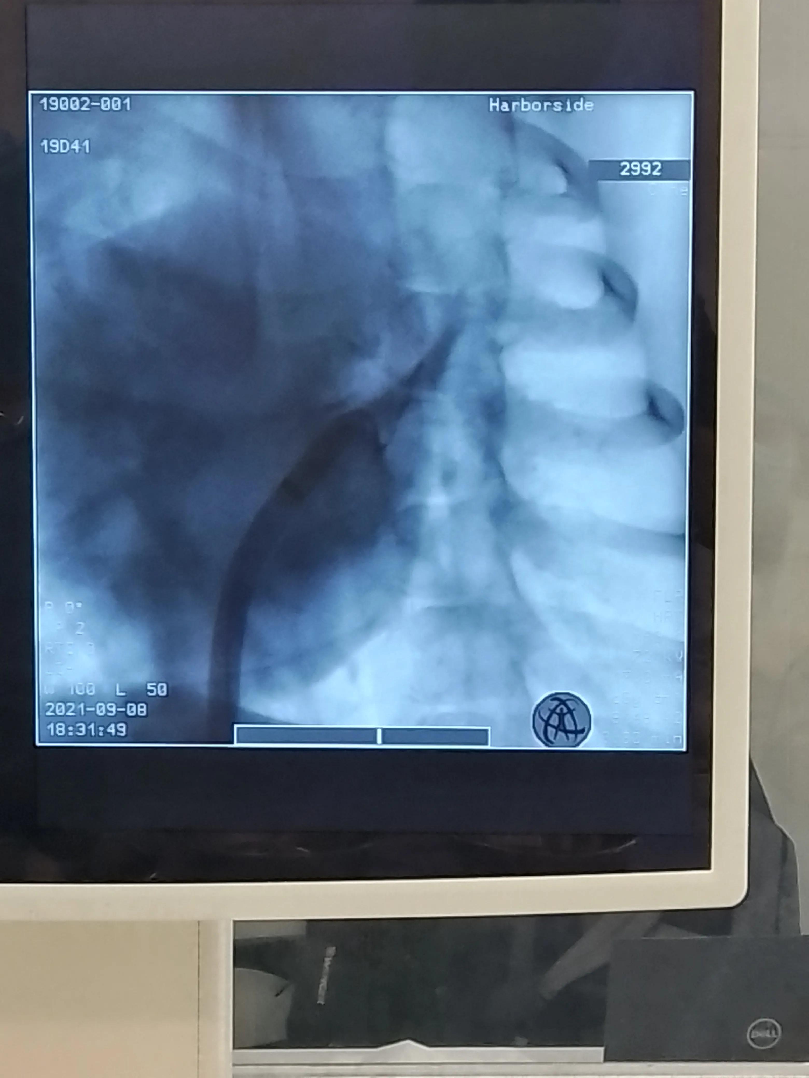 房颤射频消融术器械有哪些,脉冲消融治疗房颤品牌
