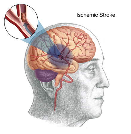 国医大师邓铁涛治62种病的经验方,邓铁涛治疗中风医案