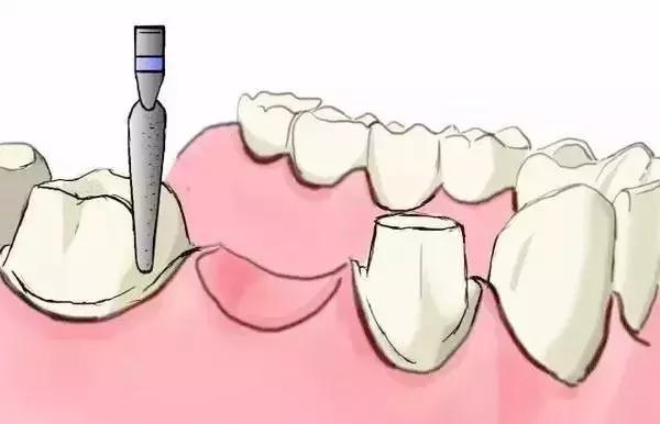 为什么做了烤瓷牙的人都后悔,烤瓷牙套弄上后悔了该怎么办