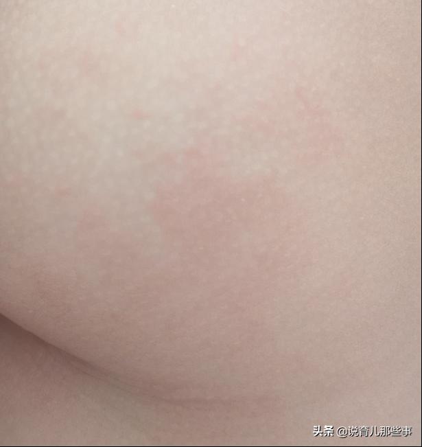 很恐怖的过敏图片,过敏发朋友圈的真实图片