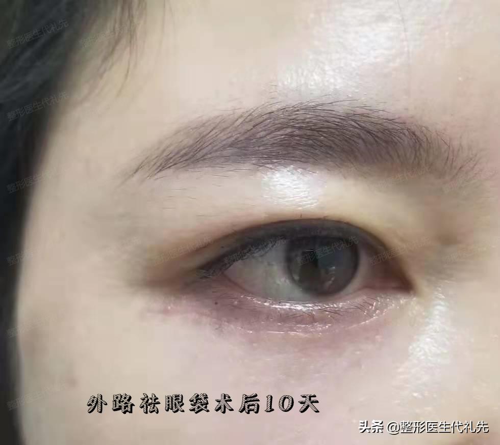 去眼袋一问一答,祛眼袋要咨询什么问题