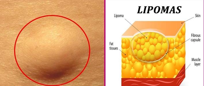 长脂肪瘤是什么引起的,脂肪瘤有什么危害脂肪瘤最怕什么