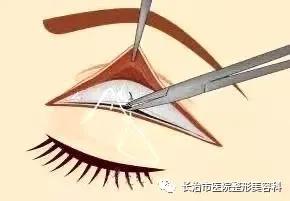 揭秘整形双眼皮内幕,割双眼皮术的价格