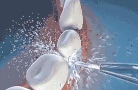 洗牙会导致牙缝变大吗动画视频,洗牙会导致牙缝变宽吗