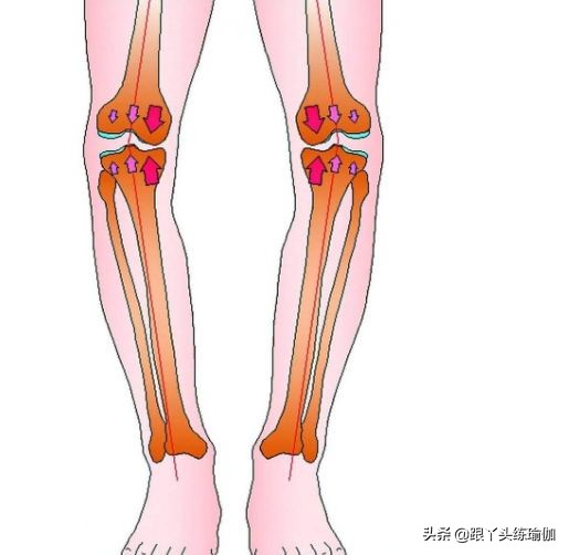 o型腿怎么矫正最有效的动作,o型腿怎么矫正最有效动作