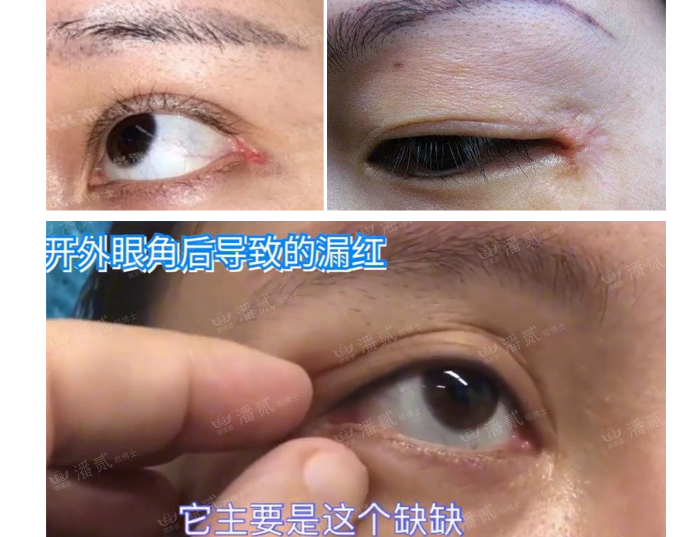 开外眼角结膜充血水肿怎么办,眼睛开外眼角有后遗症吗