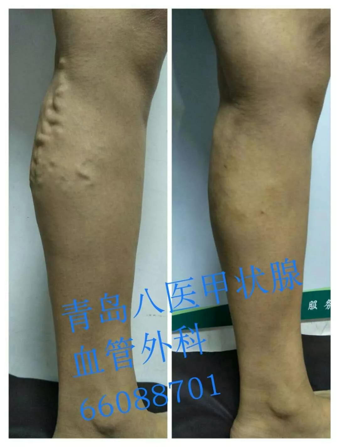 青岛第八人民医院义诊,山东青岛市立医院治疗静脉曲张