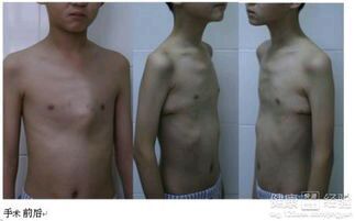 怎样预防孩子鸡胸,导致鸡胸的原因和危害