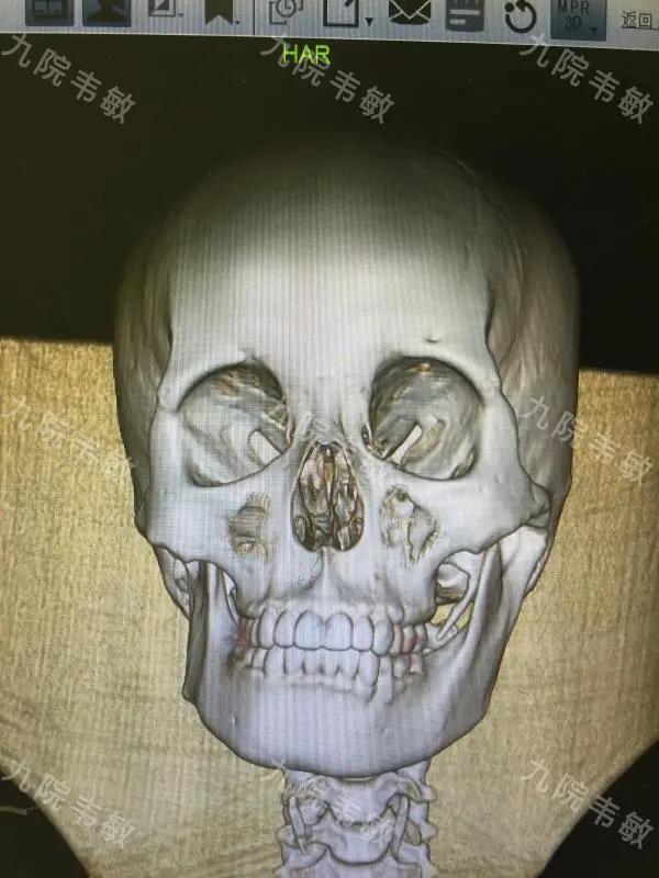 不想做正颌手术怎么改善嘴突,脸不对称挂号正畸还是正颌