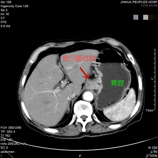 贲门癌80岁手术好还是保守治疗好,医生建议80岁老人做贲门癌手术