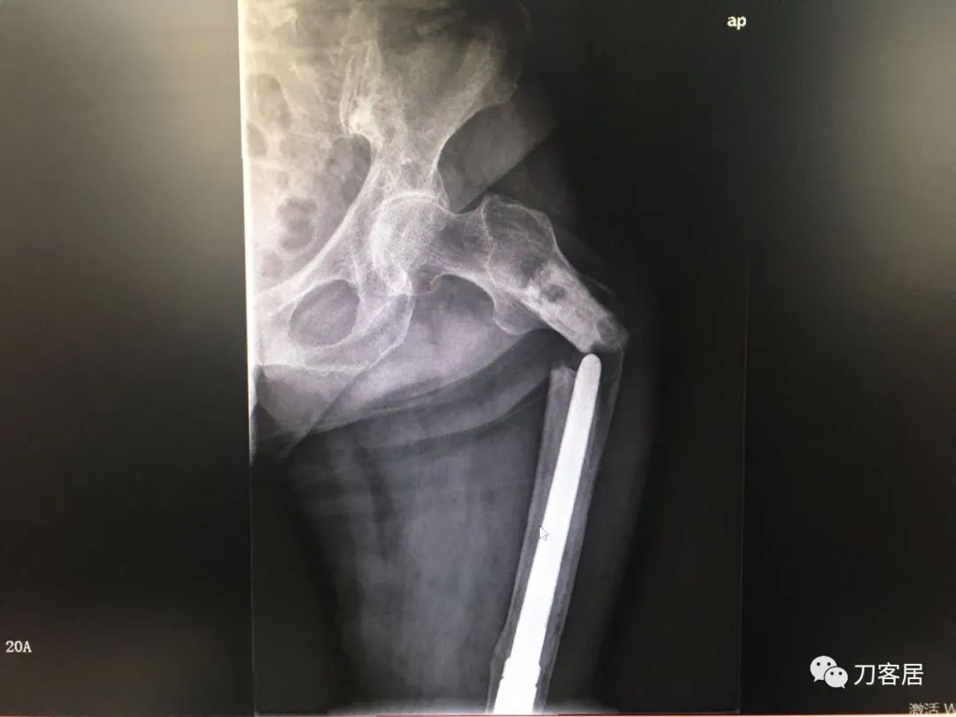 股骨胫骨骨折中医治疗方法,中药治疗股骨颈骨折