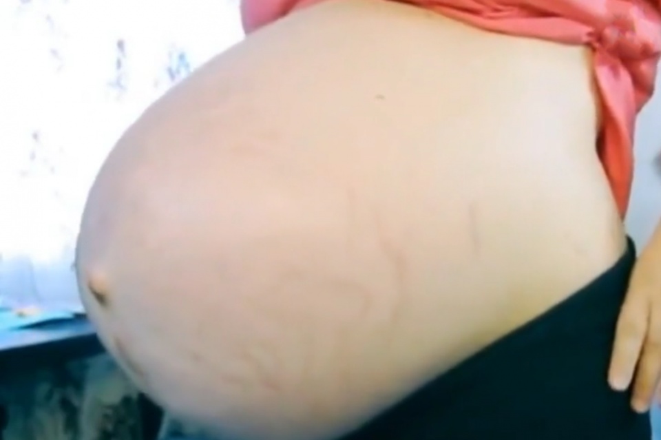 剖腹产术后有多疼？经历过的产妇都知道，有一种痛叫“举步维艰”