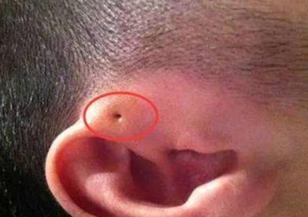 4岁宝宝耳朵里长个疙瘩,4岁男孩耳朵上长了个小孔