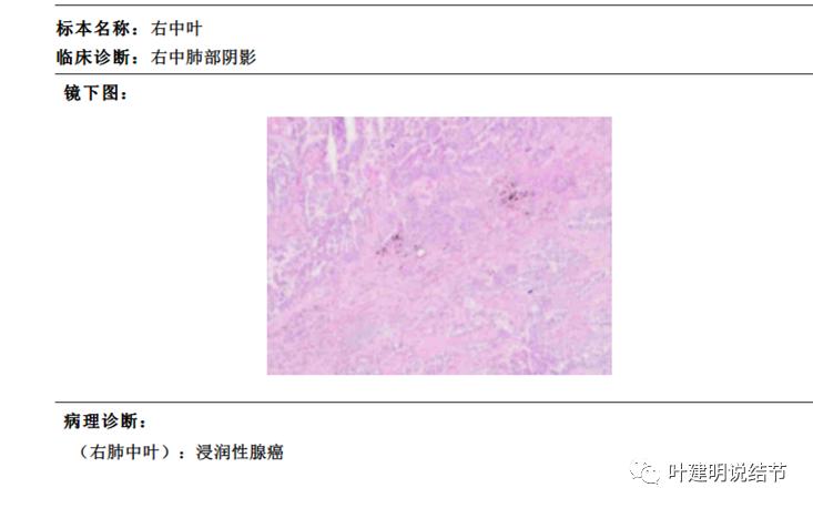 实性结节影要不要紧,实性结节穿刺活检为良性
