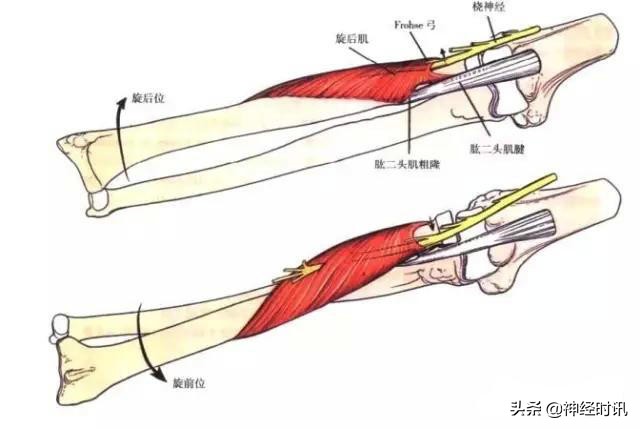 周围神经卡压解剖与分析,腓浅神经卡压解剖视频