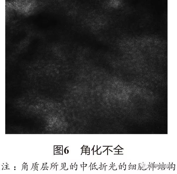 炎症性皮肤病反射式共聚焦显微镜诊断特征专家共识全文发布