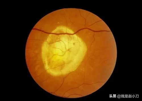 高度近视患者出现白内障的症状,高度近视轻微白内障怎么办