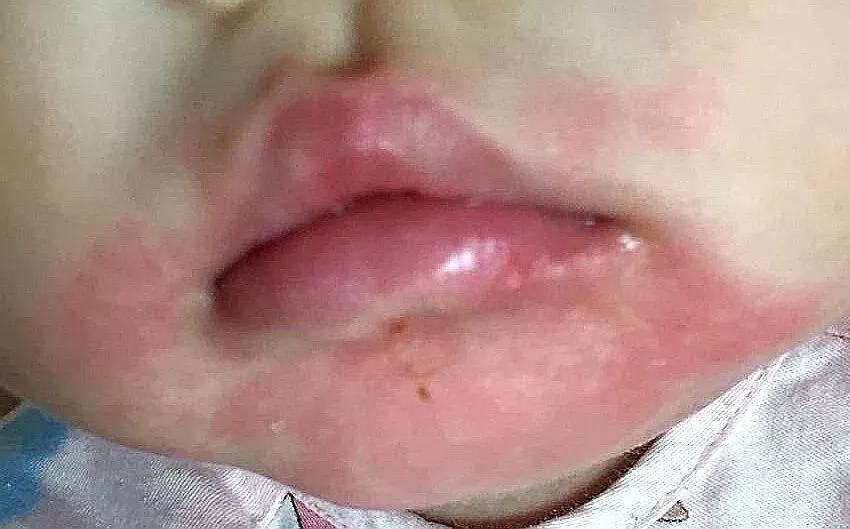 口周皮炎会留印吗,口周皮炎留下色素能好吗