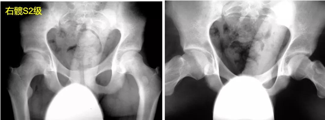 perthes可以治愈么,儿童股骨头坏死指南2020