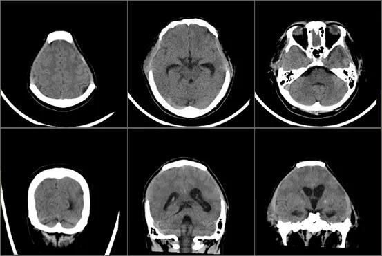 一颗智齿惹的祸,一颗智齿引发的事件