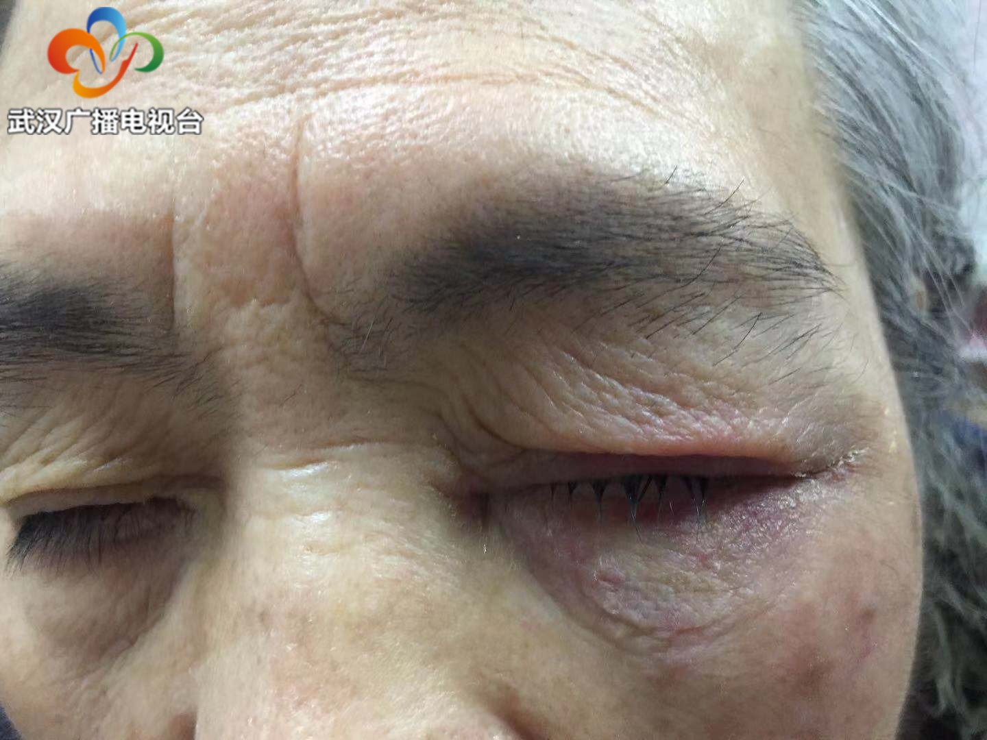 误把灰指甲药水滴到眼睛里了,眼睛误滴灰指甲药水怎么办