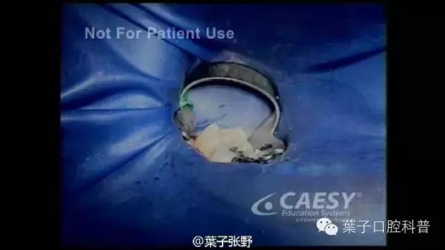 上牙龈上火突出一个鼓包,牙龈肿胀鼓包上火了吗