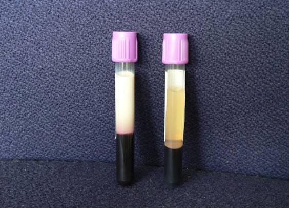 血液检测没出报告,血液化验不出来结果怎么回事