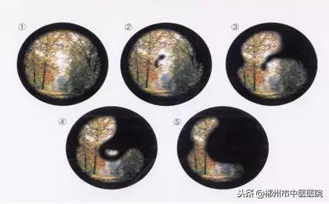 中国哪个医院治疗脑出血最好,河南治疗脑出血的最好方法