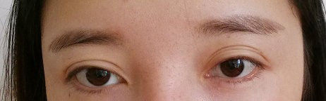 全切双眼皮提肌失败还能修复吗,什么是失败的双眼皮