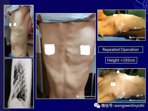 扁平胸合并漏斗胸可以手术矫正吗,扁平胸怎么手术