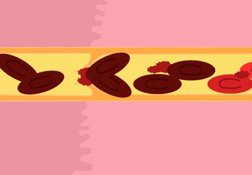 血管弹性变差怎么办,血管硬了很难再软回去