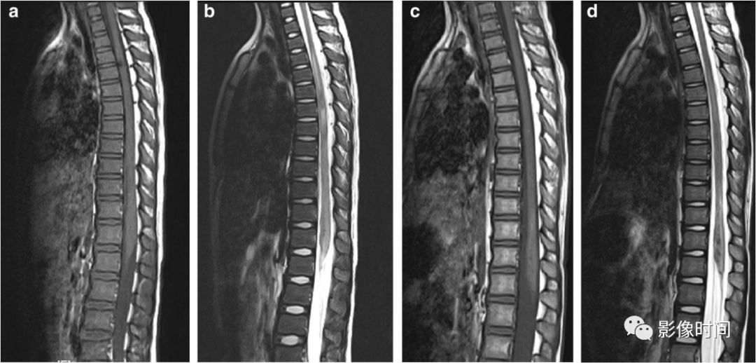 脊髓病变案例图文问诊,脊髓病变视频