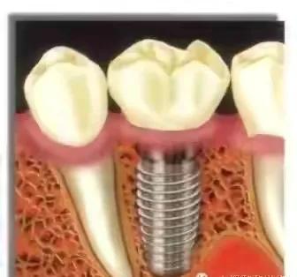种植牙手术流程图解,口腔种植牙护士手术配台流程