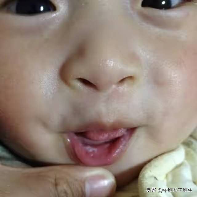 宝宝鹅口疮可以涂紫药水吗,宝宝鹅口疮长期涂制霉菌素好吗