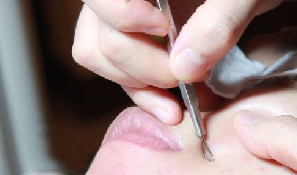 挤闭口粉刺有效吗,挤下巴闭口粉刺