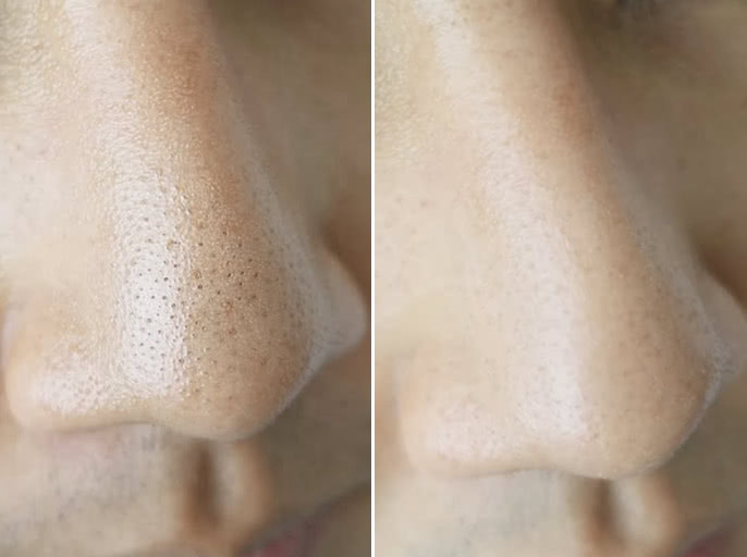 祛痘印痘坑收缩毛孔微针,微针美容是否适合你一份详细指南