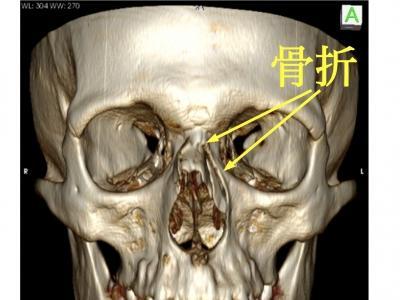 鼻子打架被打歪了治疗需要多少钱,鼻子打歪了属于什么伤