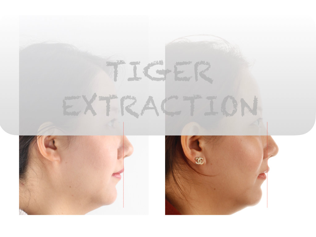 正畸医生邰怡的作品,南京牙齿矫正邰医生