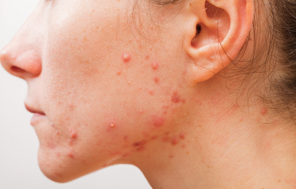 眼周皮肤干燥缺水紧急解决方法,春季风大皮肤缺水如何改善调养