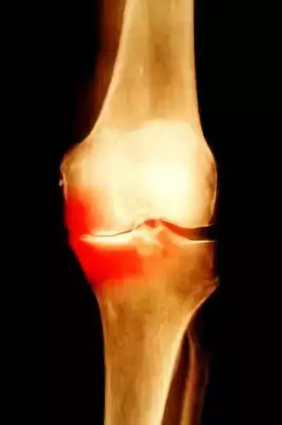 老年人膝关节疼痛蹲下不能站起,老年人膝关节伸不直加疼痛