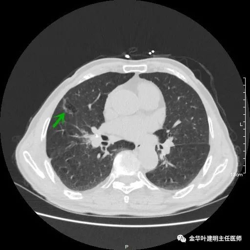 多发原发肺癌能根治吗,肺部原发性恶性肿瘤好治